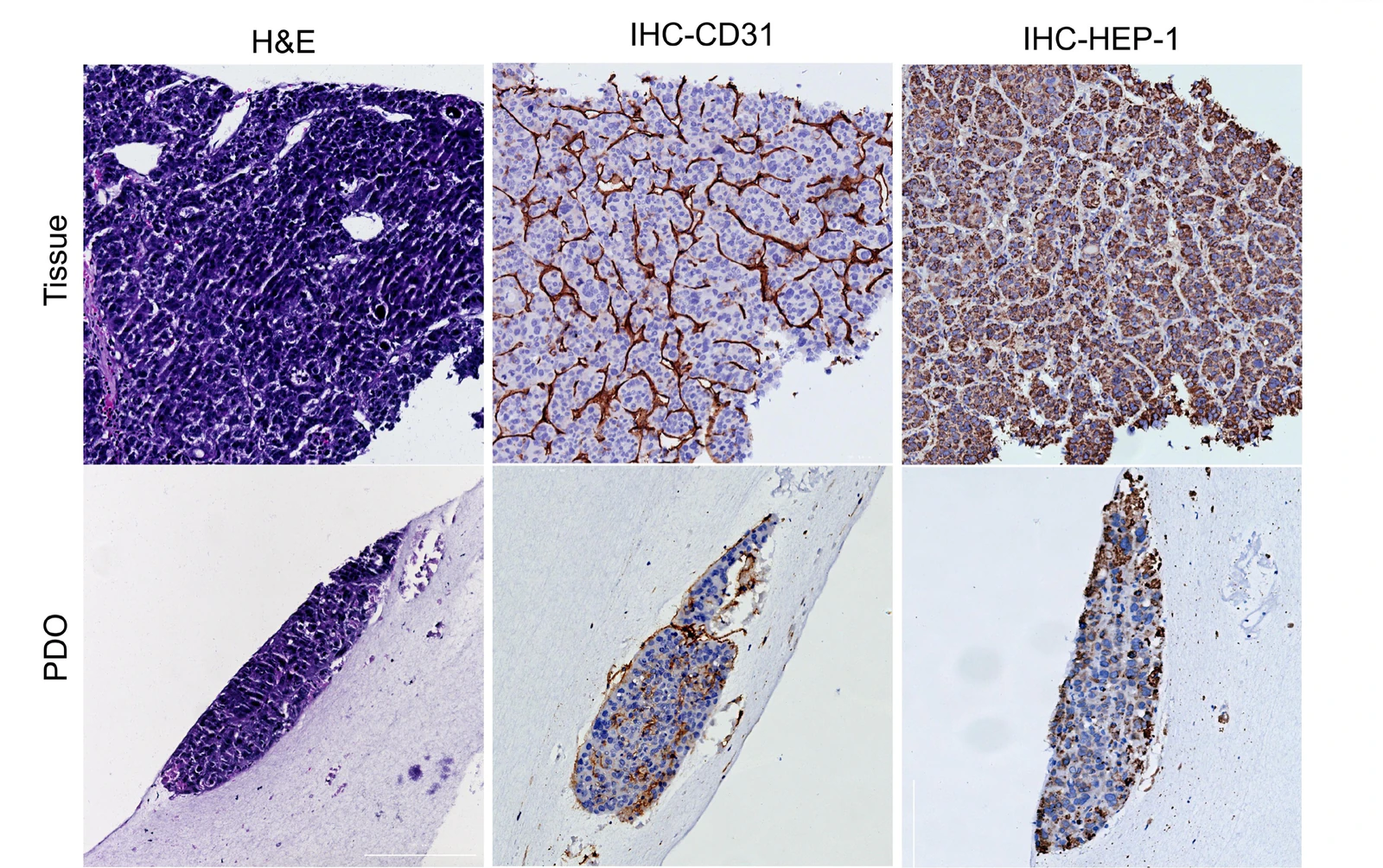 肝细胞癌原组织与PDO的H&E、CD31和HEP-1免疫组化对照