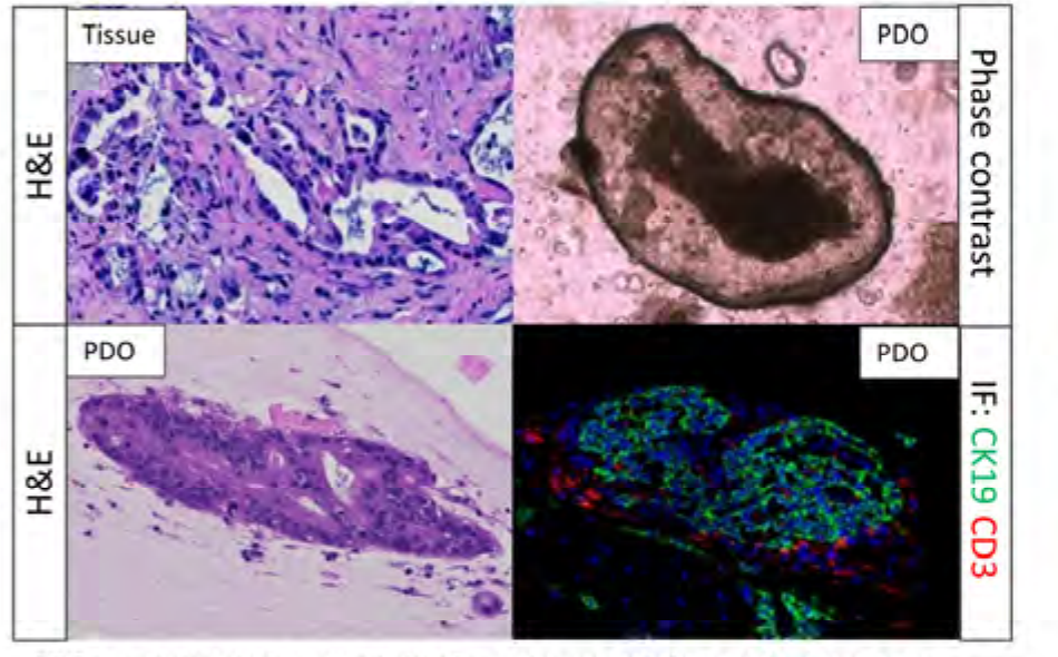 胰腺癌原组织、PDO明场、PDO组织学以及CK19和CD3免疫荧光