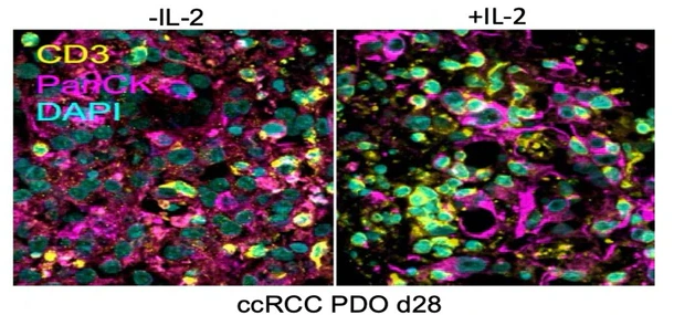 CD3, PanCK and DAPI imaging in a renal PDO with and without IL-2