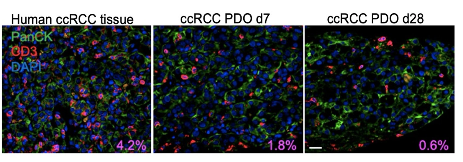 PanCK, CD3 and DAPI profiling in renal tumor tissue and PDO 2.0 across culture time