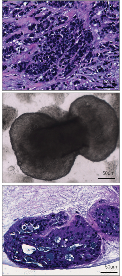 Source-tissue H&E, PDO bright-field and PDO histology for breast cancer