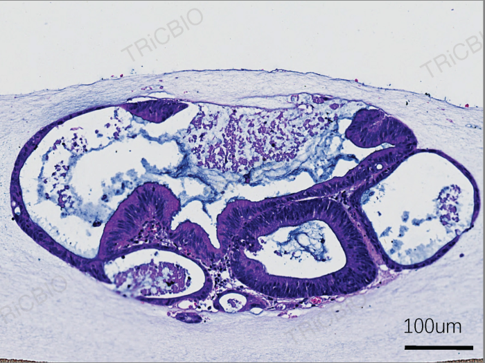 Histology of a colorectal cancer PDO